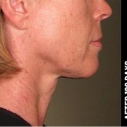 Ultherapy Before & After Patient #1557